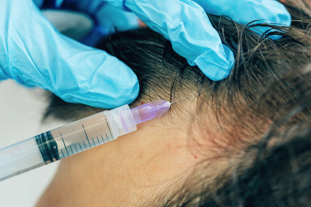 PRP-Behandlung gegen Geheimratsecken